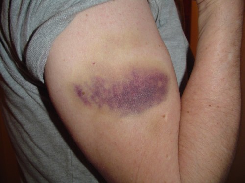 bruise