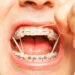 braces